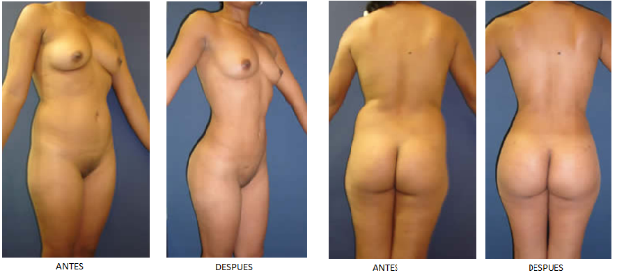AntesYDespuesLiposuccion@.png
