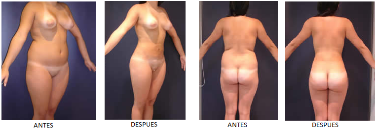LiposuccionColombia@.png